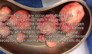 Image result for 11 Cm Fibroid