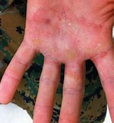 Image result for Fungal Skin Rash On Hands