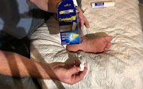 Image result for Wart After Compound W