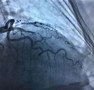 Image result for angiograf�a