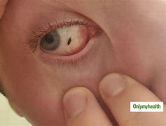Image result for Fly Eggs in Eye
