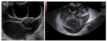 Image result for Cystadenomas Ovarian Cyst Ultrasound