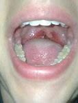 Image result for Strep Throat On Roof of Mouth
