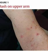Image result for Warts On Upper Arm