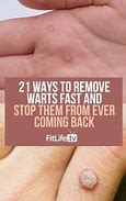 Image result for Flat Wart Treatment