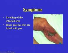 Image result for Flesh-Eating Bacteria Signs