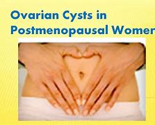 Image result for Ovarian Cyst After Menopause