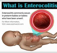 Image result for enterocolitis