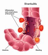 Image result for Diverticulitis