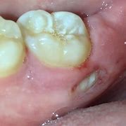 Image result for Bone Fragments After Tooth Extraction