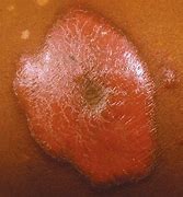 Image result for Immune Reconstitution Inflammatory Syndrome