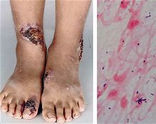 Image result for Skin Ulcer Erosia