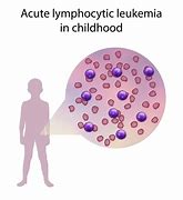 Image result for Acute Lymphocytic Leukemia