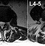Image result for Lumbar Spine MRI Results