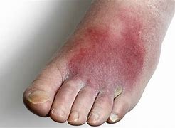 Image result for Cellulitis