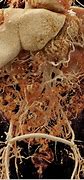 Image result for Carcinoid Tumor Small Intestine