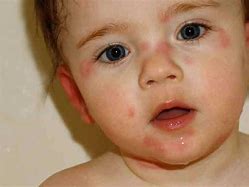 Image result for Peanut Allergy Reaction