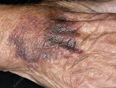 Image result for CPR Bruise Hand