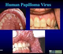 Image result for Human Papillomavirus Lips