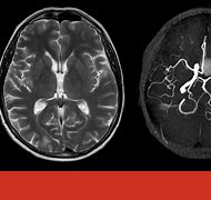 Image result for MRA Brain Aneurysm