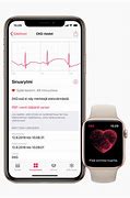 Image result for Lbbb Apple Watch ECG