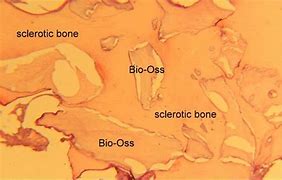 Image result for Bio-Oss