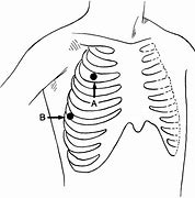 Image result for Chest Tube Diagram to Fill In