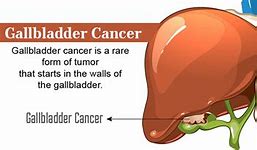Image result for Gallbladder Cancer Gross Image