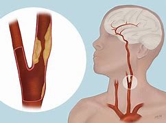 Image result for Clogged Artery in Neck