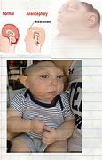 Image result for Anencephaly Symptoms
