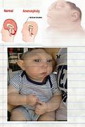 Image result for People with Anencephaly