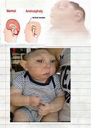 Image result for Exencephaly vs Anencephaly