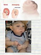 Image result for Anencephaly Development