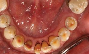 Image result for Jaw Necrosis