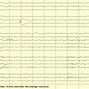 Image result for Vertex Sharp Waves EEG
