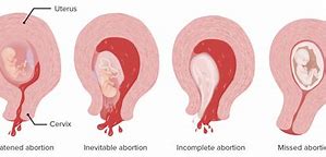 Image result for abortp