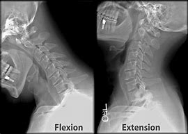 Image result for Normal Neck X-ray