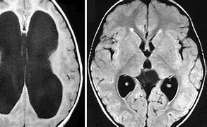 Image result for Hydrocephalus On CT Scan