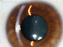 Image result for Intraocular Lens