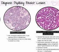 Image result for Adenoma vs Papilloma Vs. Poly Papilloma