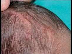 Image result for Skin Cancer On Your Scalp
