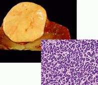Image result for Stage 4 Renal Cell Carcinoma
