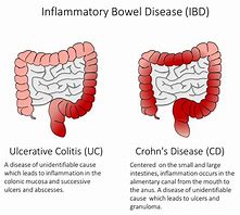 Image result for Inflammatory Bowel Disease IBD