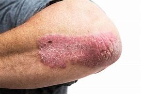 Image result for Eczema in Genital Area
