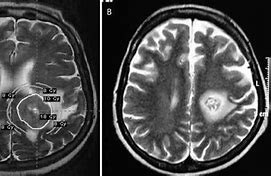 Image result for T2 Axial Blade Lesions On Brain MRI