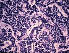 Image result for Carcinoid Cytology