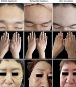 Image result for Plane Warts On Face
