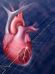Image result for Myocardial Infarction Heart