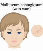 Image result for Molluscum Contagiosum in Tagalog