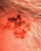 Image result for What Does Melanoma Skin Cancer Look Like